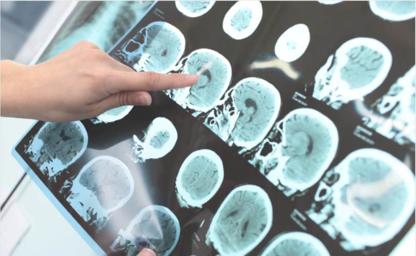 Mutuelle Mieux-Etre fait le point sur un nouveau médicament contre la maladie de l'Alzheimer